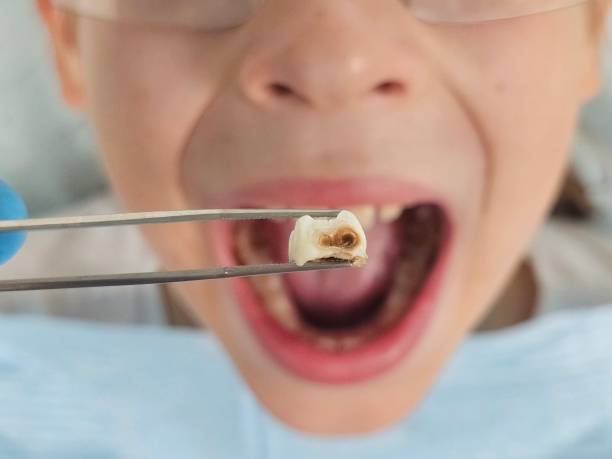 Best Emergency Dental Care for Abscessed Tooth in Prunedale, CA